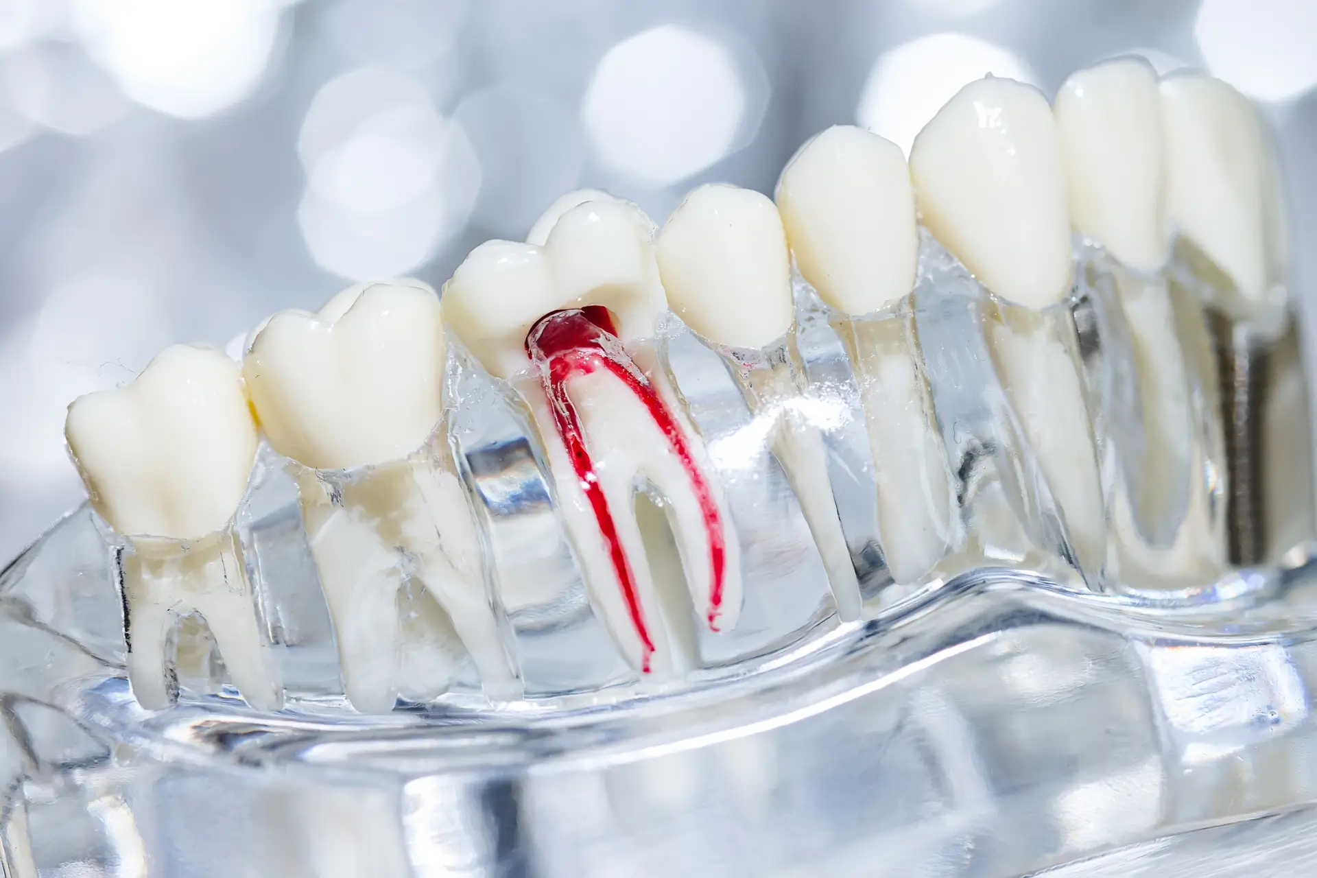 Root Canal Therapy: What It Is, How It Works, and What to Expect 30 Root canal therapy4 Root Canal Therapy: What It Is, How It Works, and What to Expect