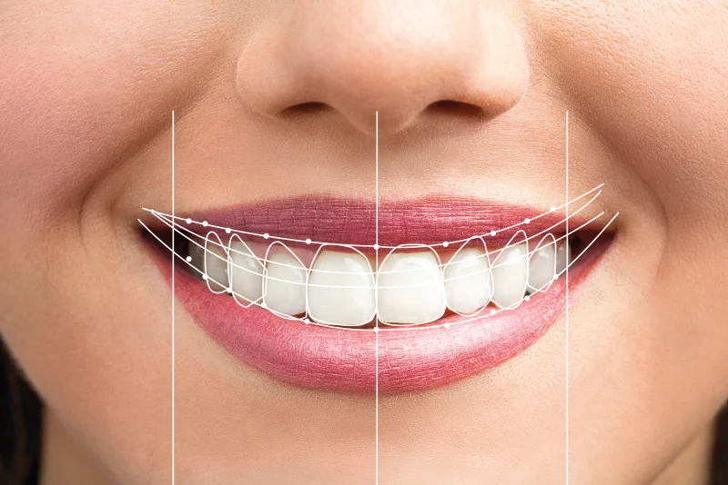 Smile makeover (Costs, Treatments & Natural-Looking Results) 22 Smile makeover1 Smile makeover (Costs, Treatments & Natural-Looking Results)