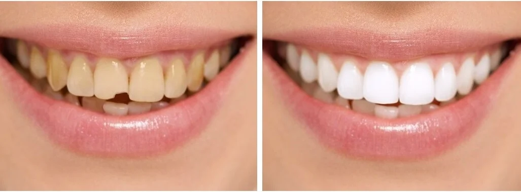 Smile makeover (Costs, Treatments & Natural-Looking Results) 24 Smile makeover3 Smile makeover (Costs, Treatments & Natural-Looking Results)