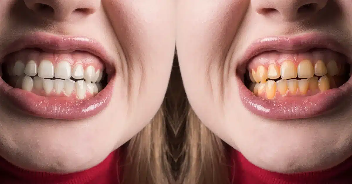 Teeth whitening Teeth whitening (Best Methods, Costs & Fastest Results)