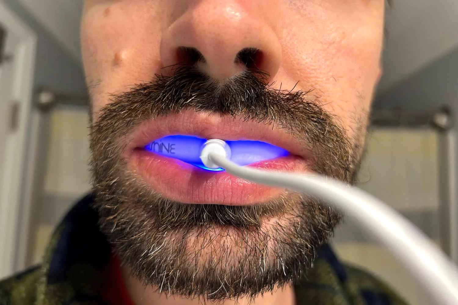 Teeth whitening1 Teeth whitening (Best Methods, Costs & Fastest Results)