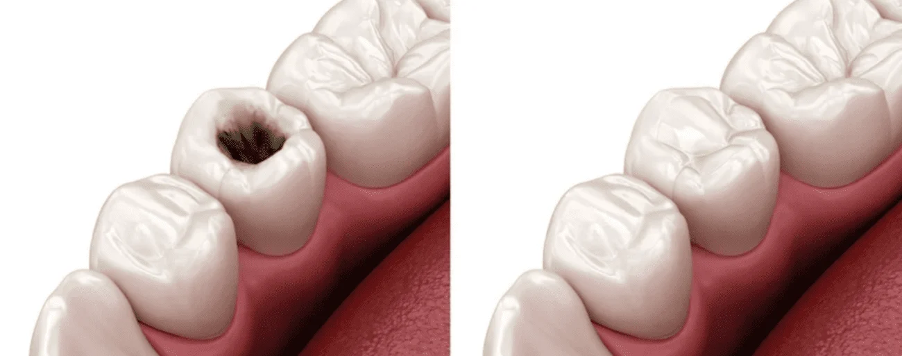 Tooth filling​ Tooth filling​s (Cost, Types & Benefits Explained)