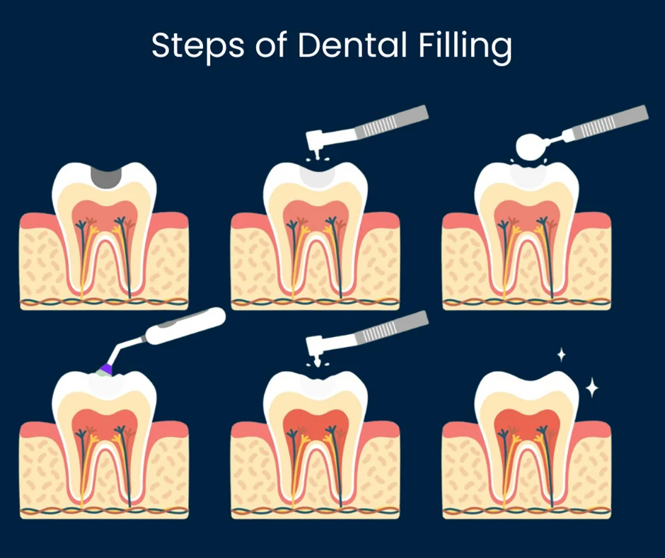 Tooth filling​1 Tooth filling​s (Cost, Types & Benefits Explained)