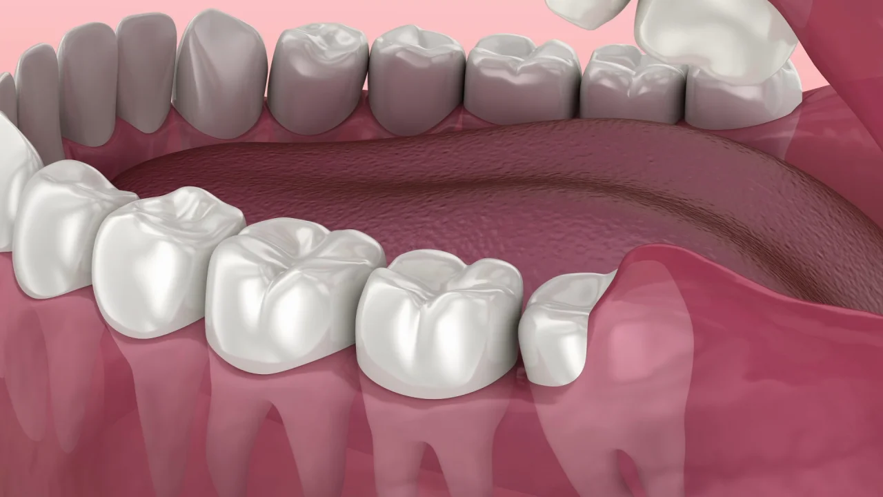 Wisdom Teeth Wisdom Teeth (Pain, Symptoms, Removal & When to Keep Them)