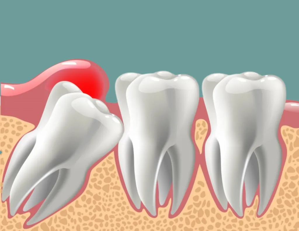Wisdom Teeth1 Wisdom Teeth (Pain, Symptoms, Removal & When to Keep Them)