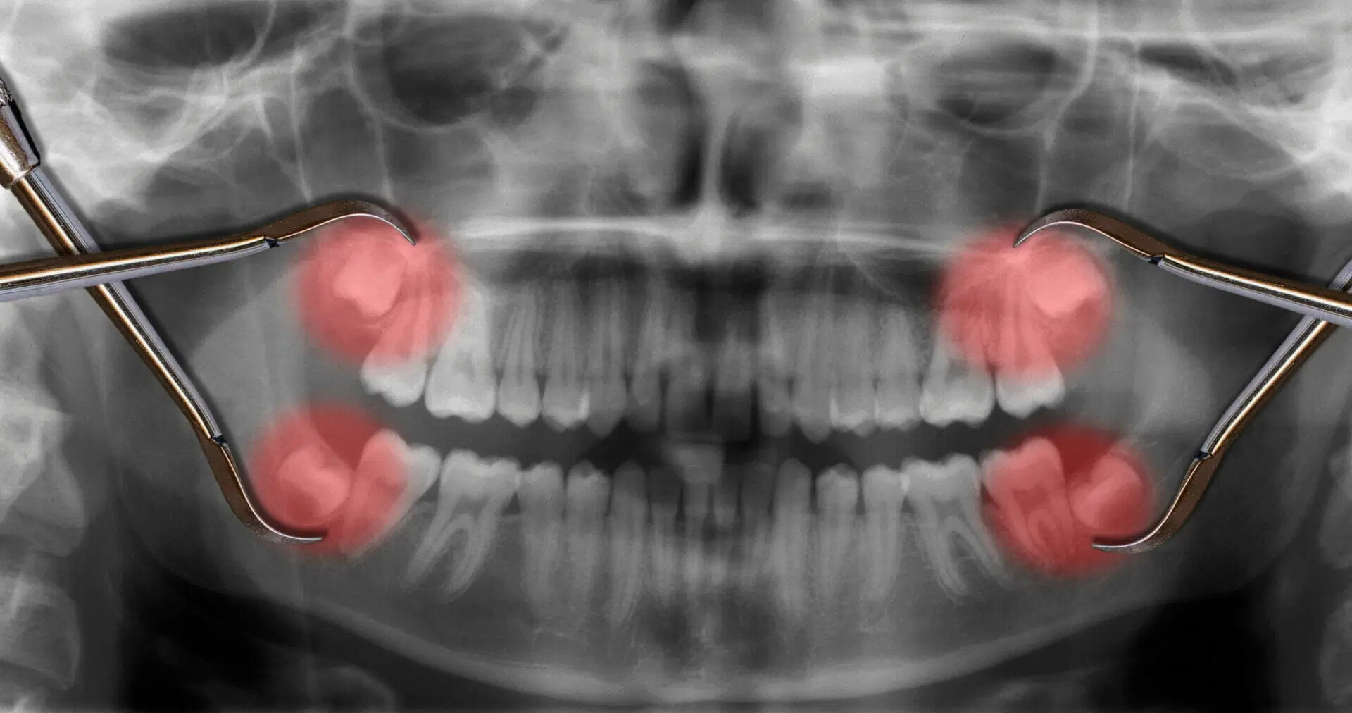 Wisdom Teeth2 Wisdom Teeth (Pain, Symptoms, Removal & When to Keep Them)