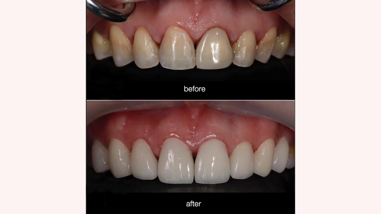 composite veneers1 Composite Veneers (Cost, Lifespan & What to Expect After 5 Years)