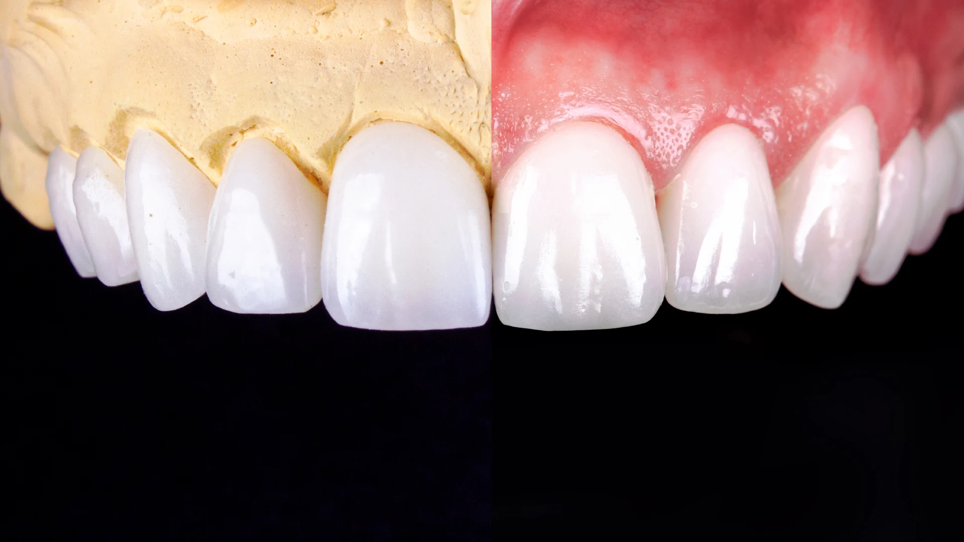 composite veneers2 Composite Veneers (Cost, Lifespan & What to Expect After 5 Years)