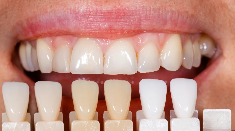 composite veneers4 Composite Veneers (Cost, Lifespan & What to Expect After 5 Years)