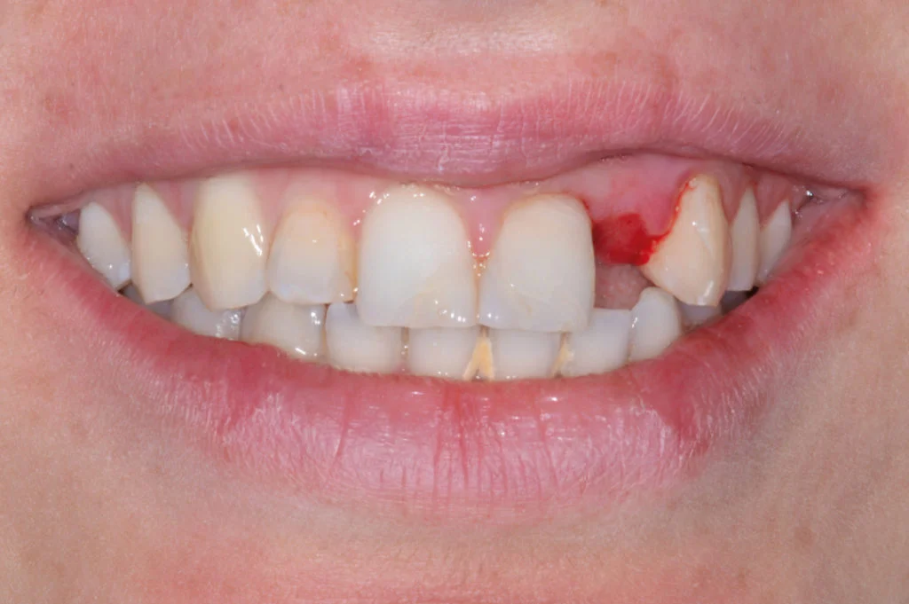 dental bone graft2 Dental Bone Graft (Costs, Pain Level, Recovery Timeline)