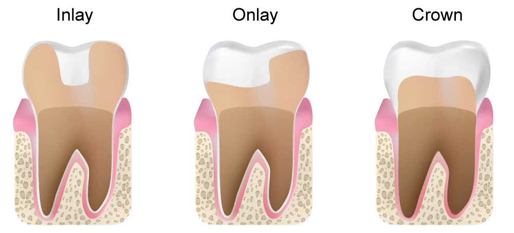dental inlays and onlays1 Dental inlays and onlays​ (Benefits, Costs & Procedure Explained)