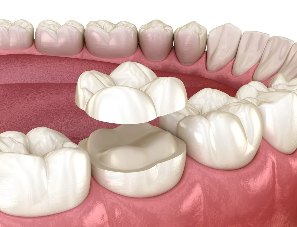 dental inlays and onlays2 Dental inlays and onlays​ (Benefits, Costs & Procedure Explained)