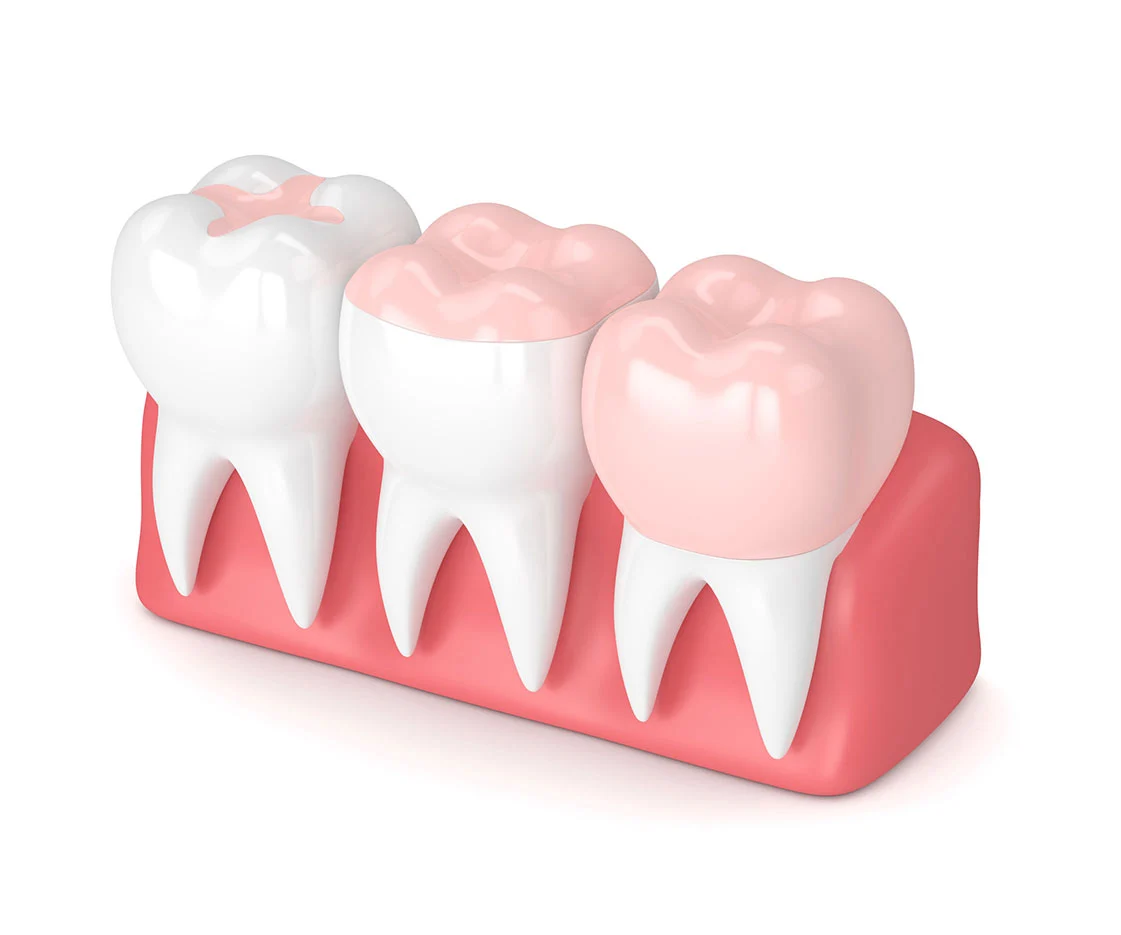 dental inlays and onlays3 Dental inlays and onlays​ (Benefits, Costs & Procedure Explained)