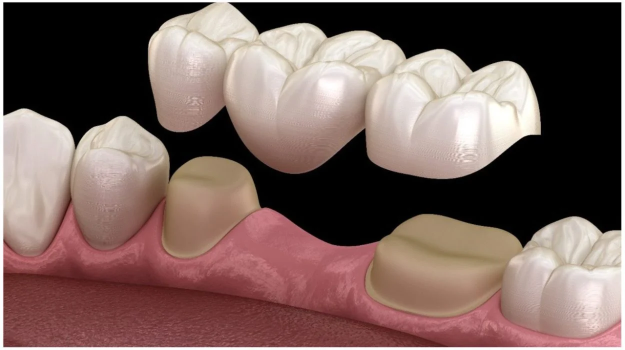 Dental Prosthetics (Types, Benefits, and Choosing the Right Option) 21 dental prosthetics1 Dental Prosthetics (Types, Benefits, and Choosing the Right Option)