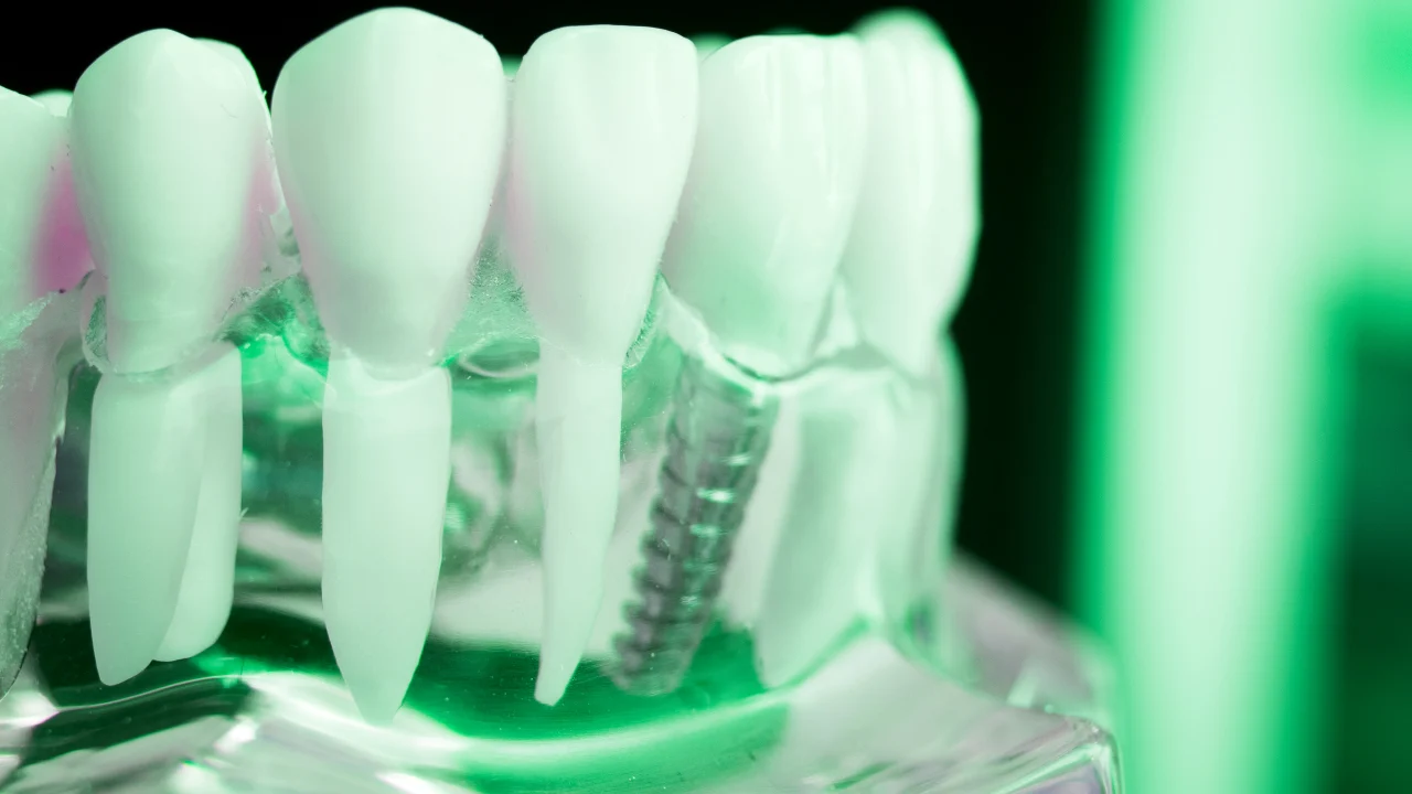 Dental Prosthetics (Types, Benefits, and Choosing the Right Option) 22 dental prosthetics4 Dental Prosthetics (Types, Benefits, and Choosing the Right Option)