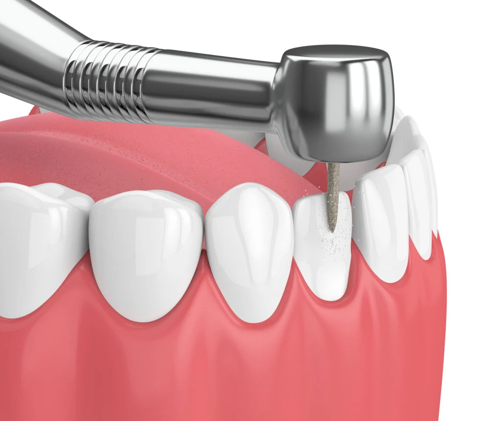 Dental Reshaping (Costs, Pain Level, Safety & Real Benefits) 17 dental reshaping2 Dental Reshaping (Costs, Pain Level, Safety & Real Benefits)