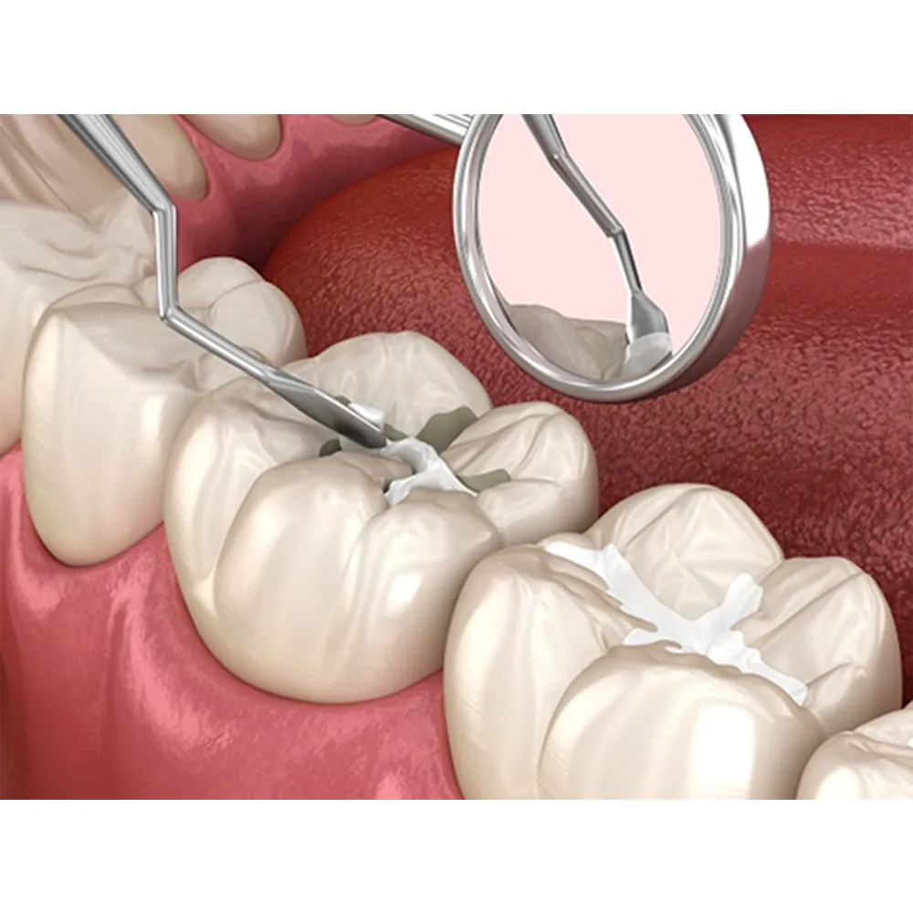 dental sealants Dental Sealants (Cost, Lifespan, Risks & Who Should Get Them)