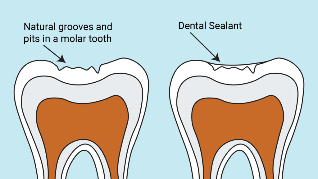 dental sealants1 Dental Sealants (Cost, Lifespan, Risks & Who Should Get Them)