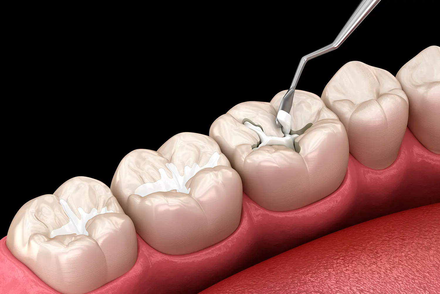 dental sealants2 Dental Sealants (Cost, Lifespan, Risks & Who Should Get Them)