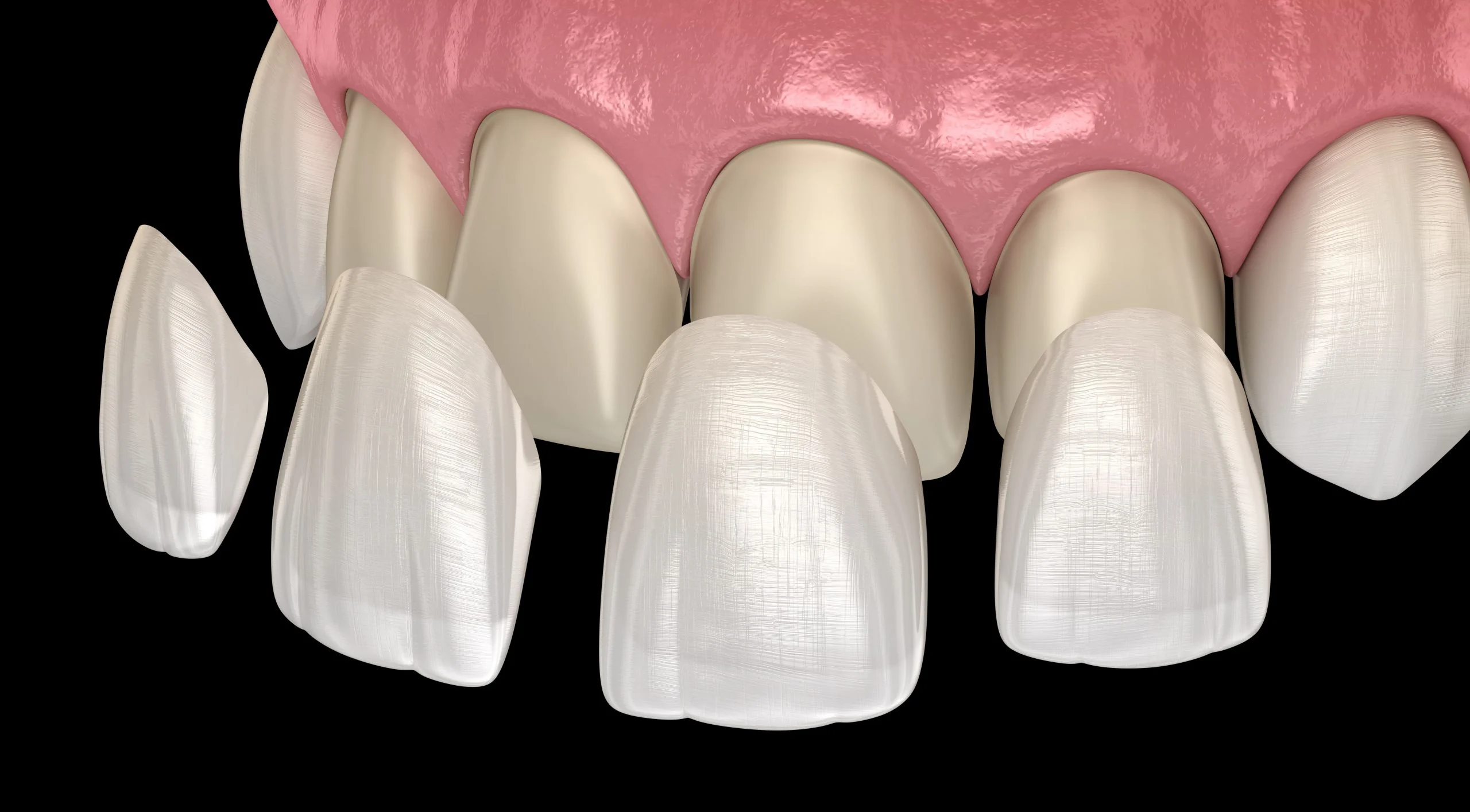 dental veneers Dental Veneers (Cost, Lifespan, Pros, Procedure & Natural Look)