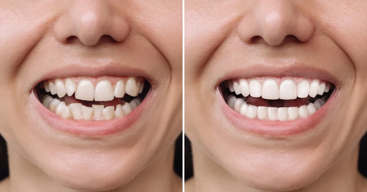 dental veneers1 Dental Veneers (Cost, Lifespan, Pros, Procedure & Natural Look)