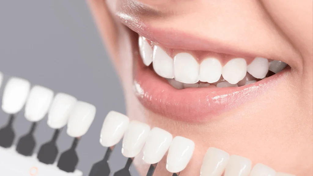 dental veneers2 Dental Veneers (Cost, Lifespan, Pros, Procedure & Natural Look)