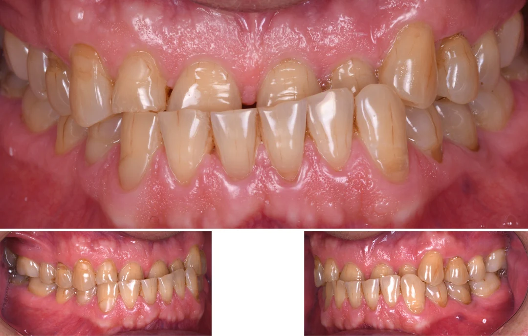 full mouth rehabilitation1 Full Mouth Rehabilitation (Smile Restoration, Cost & Recovery Explained)