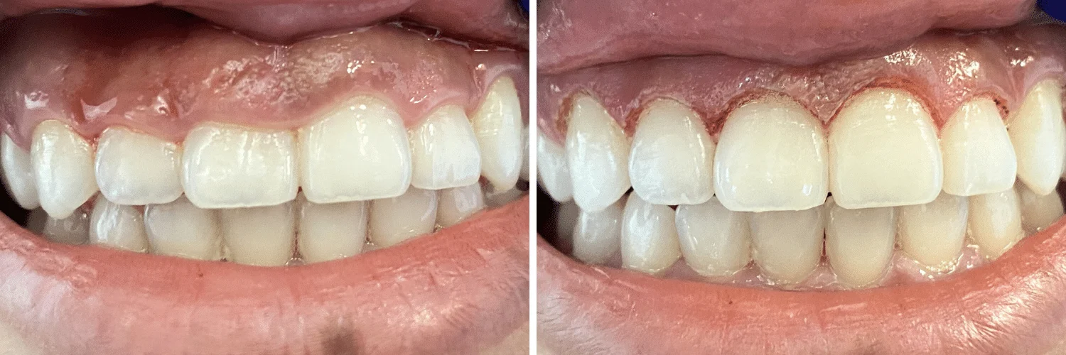 Gum Contouring: Laser, Recovery, Cost & What to Expect 21 gum contouring Gum Contouring: Laser, Recovery, Cost & What to Expect