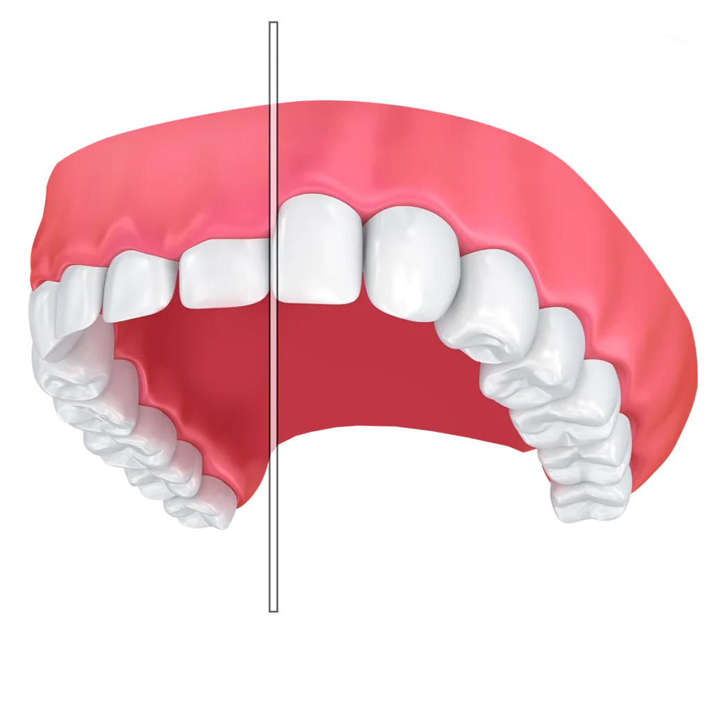 Gum Contouring: Laser, Recovery, Cost & What to Expect 24 gum contouring3 Gum Contouring: Laser, Recovery, Cost & What to Expect