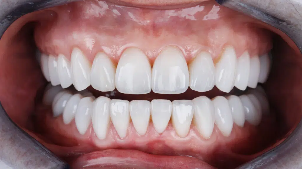 porcelain veneers1 Porcelain Veneers (Cost, Procedure, Benefits & How Long They Last)