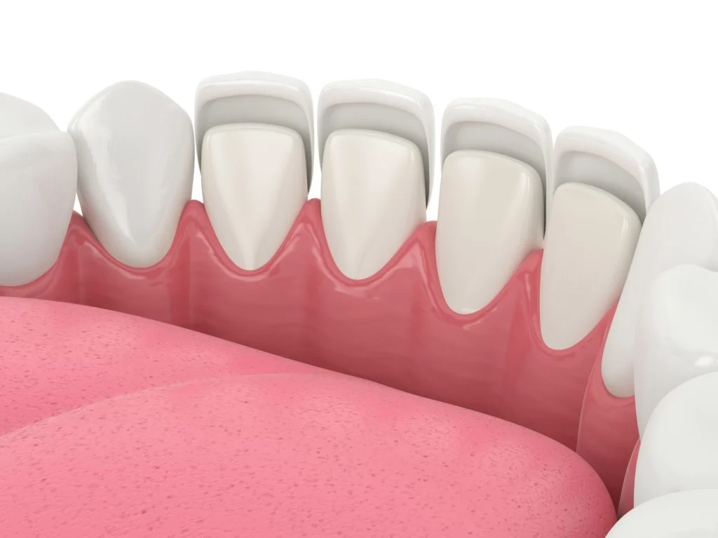 porcelain veneers2 Porcelain Veneers (Cost, Procedure, Benefits & How Long They Last)