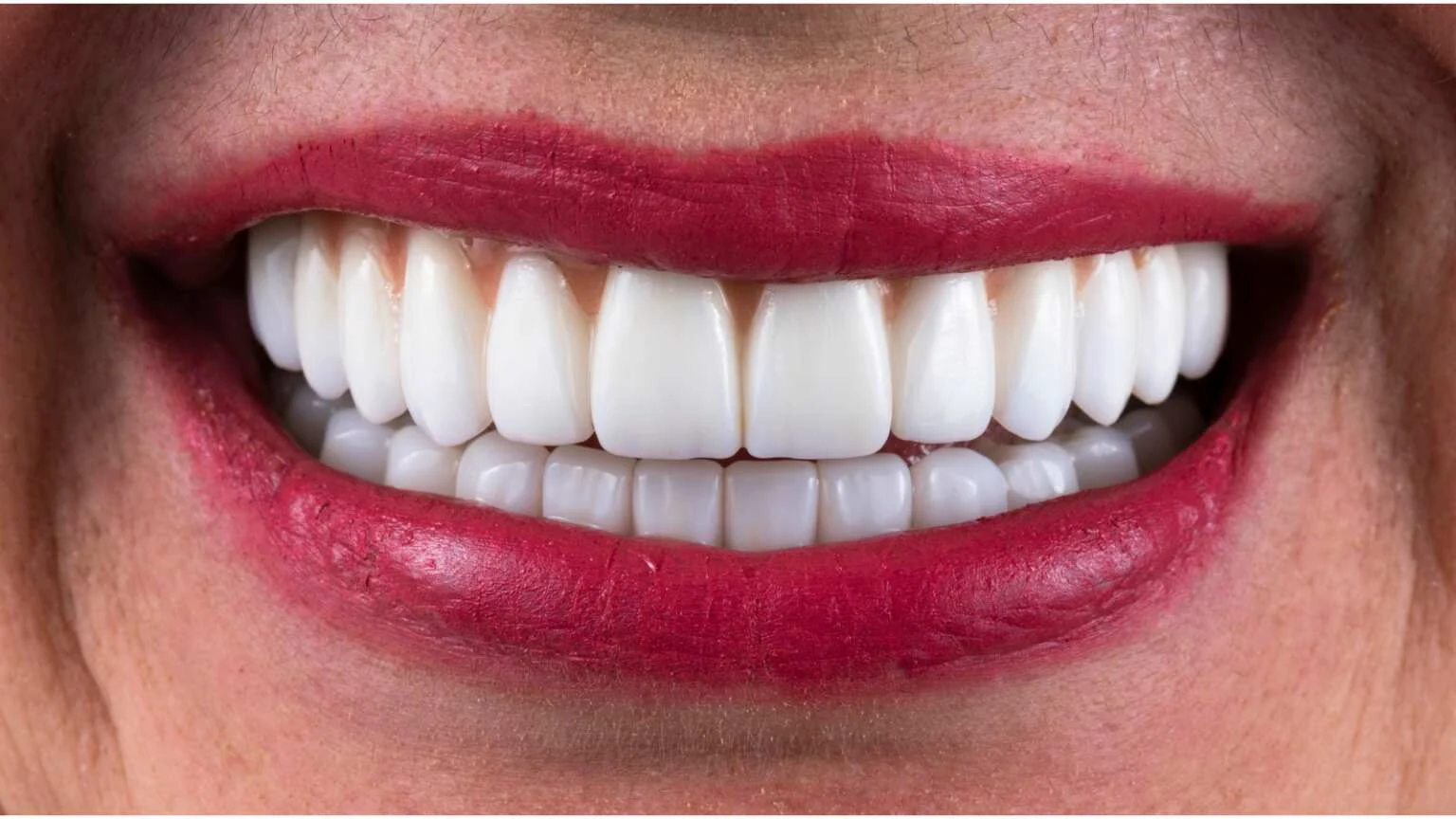 porcelain veneers3 Porcelain Veneers (Cost, Procedure, Benefits & How Long They Last)