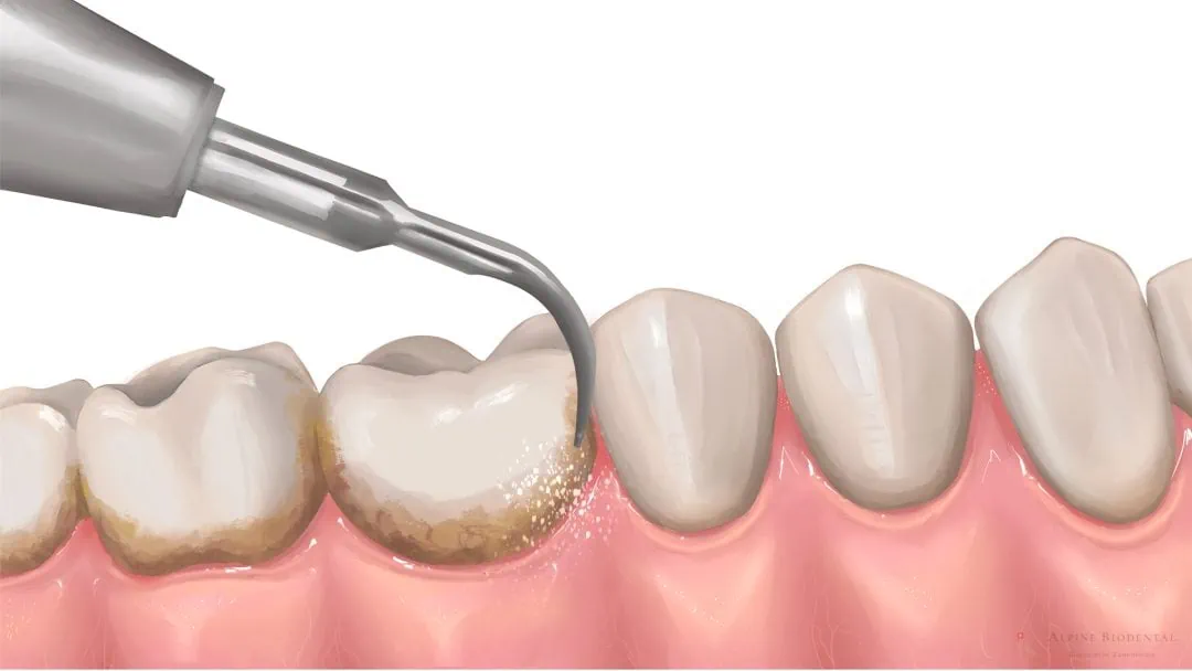 Professional Dental Cleaning (Costs, Benefits & What to Expect) 23 professional dental cleaning3 Professional Dental Cleaning (Costs, Benefits & What to Expect)