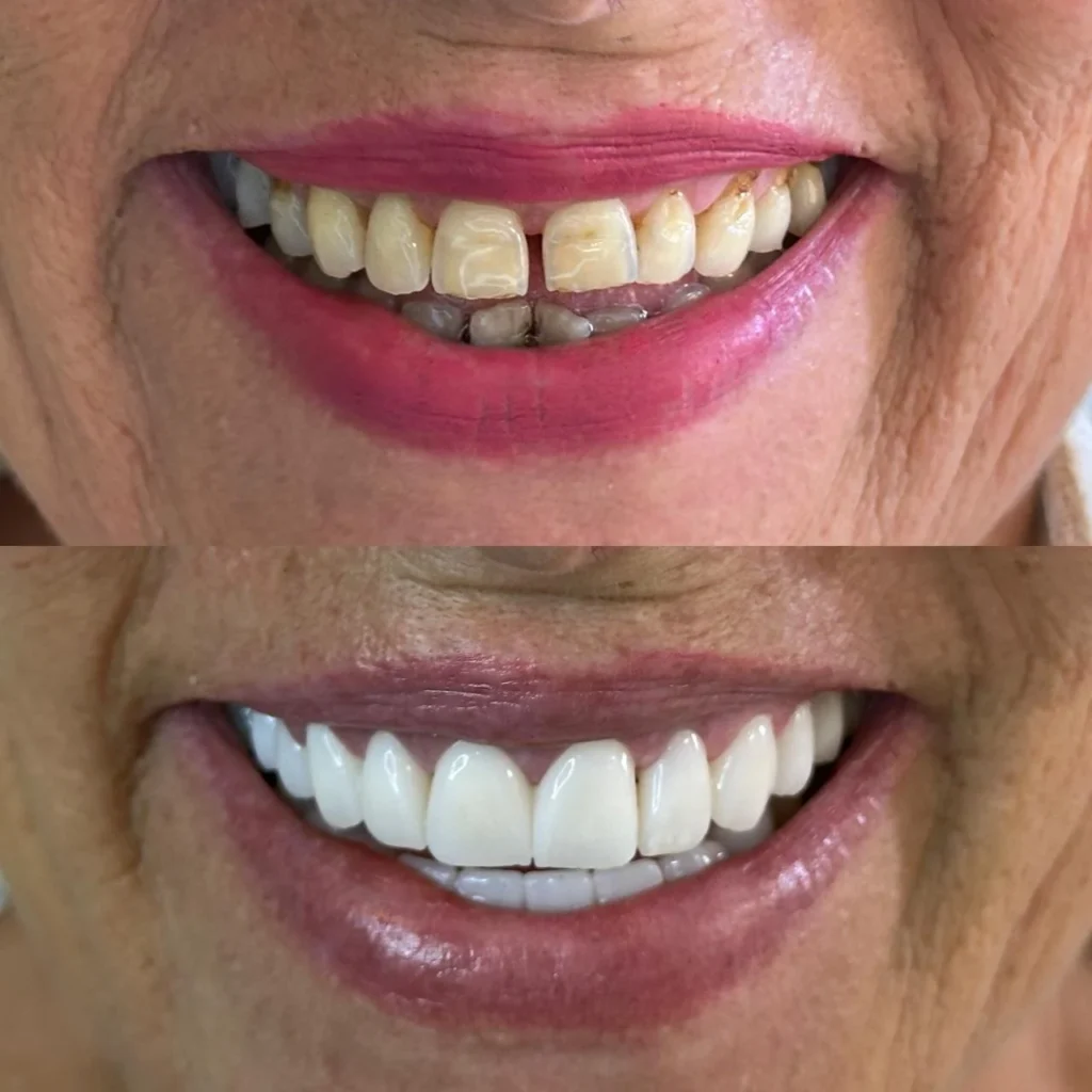 zirconia crowns Albania Tradition