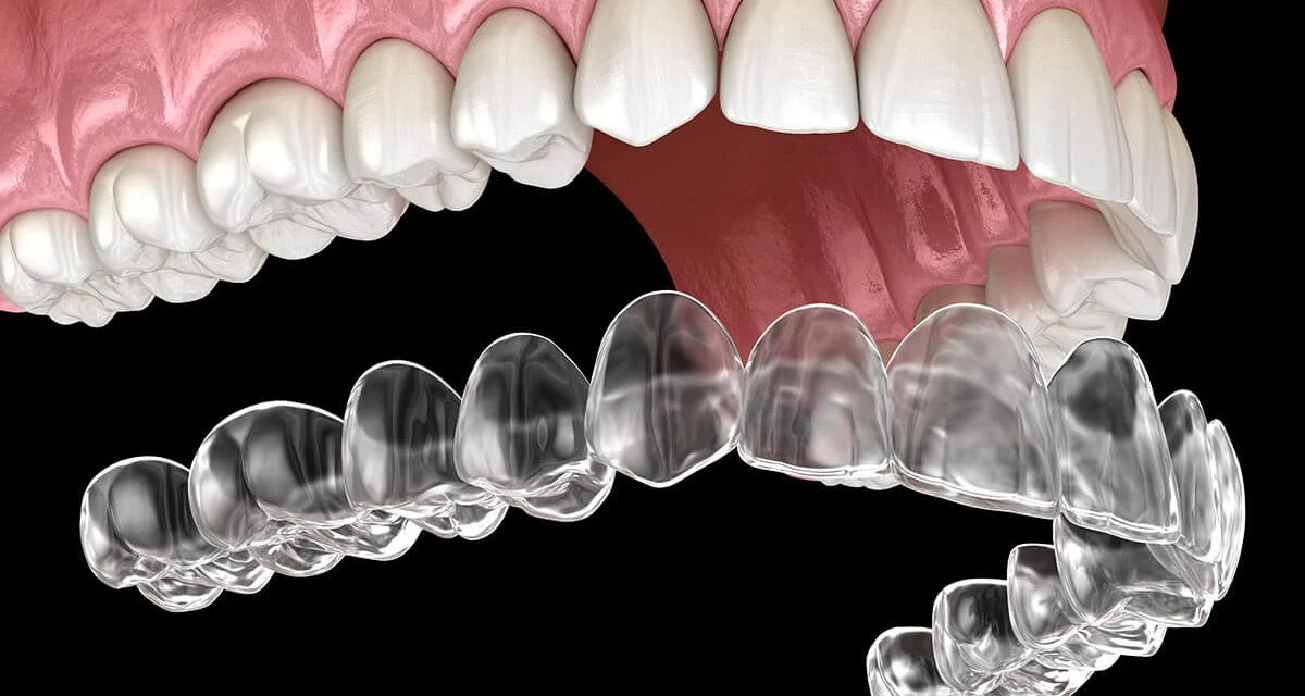 Aligners: Your Straighter Smile (Invisible, Cost & Brands) 6 Aligners