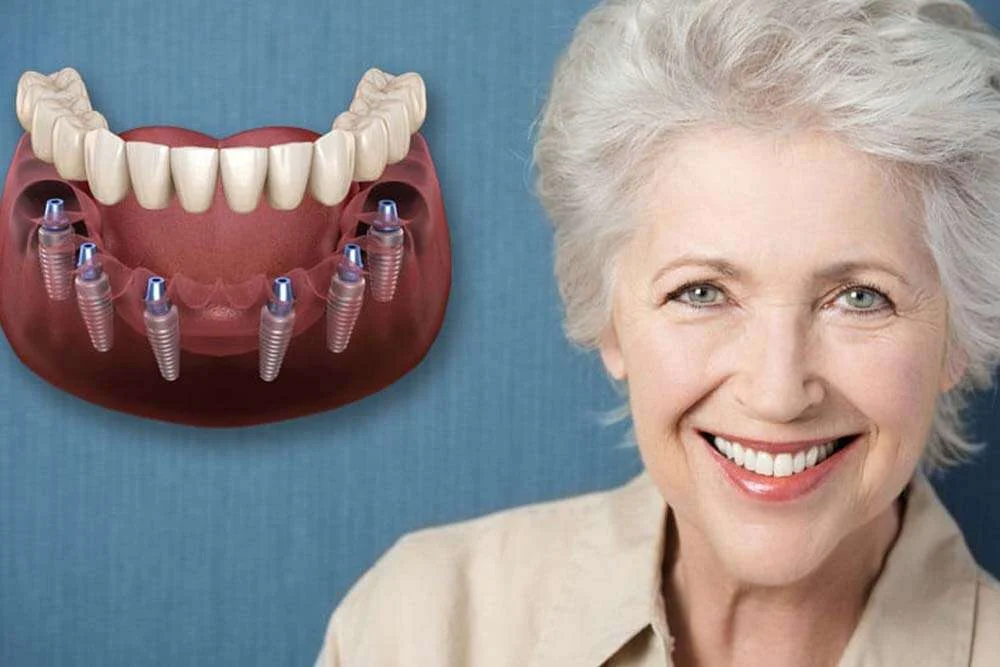 All On 6 Dental Implants 2 All On 6 Dental Implants (Cost, Procedure & Best Candidates)
