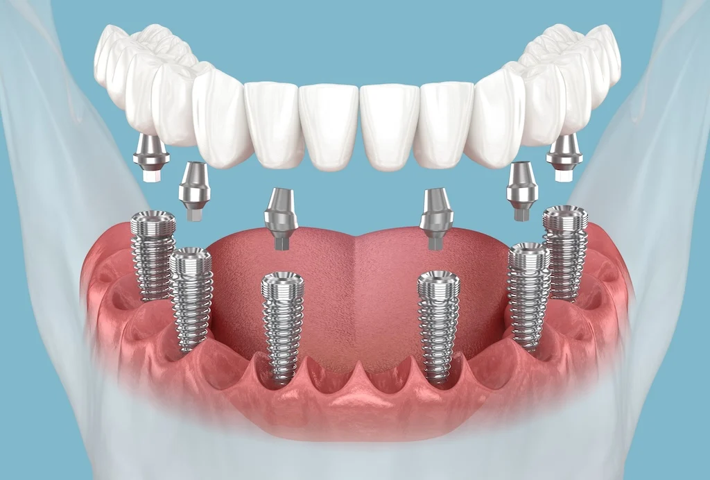 All On 6 Dental Implants All On 6 Dental Implants (Cost, Procedure & Best Candidates)