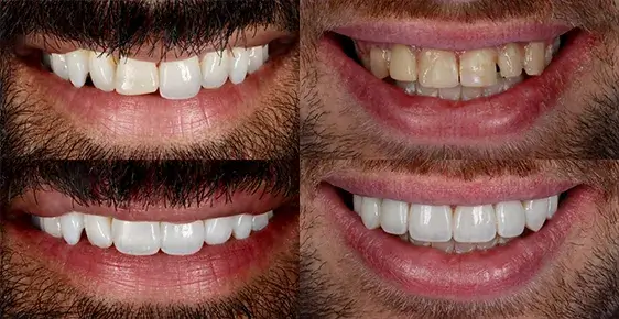 Bonded Teeth (UK Cost, Pain & If They Look Fake) 6 Bonded Teeth