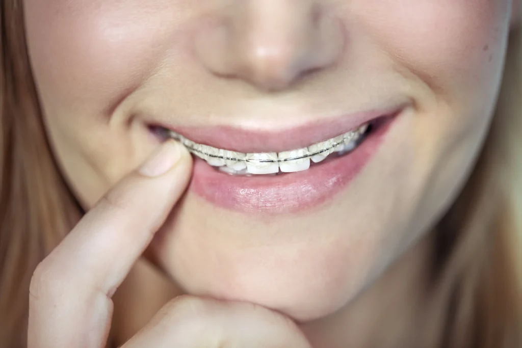 Braces UK Price1 Braces UK Price (NHS, Private, Invisalign, Monthly Plans)