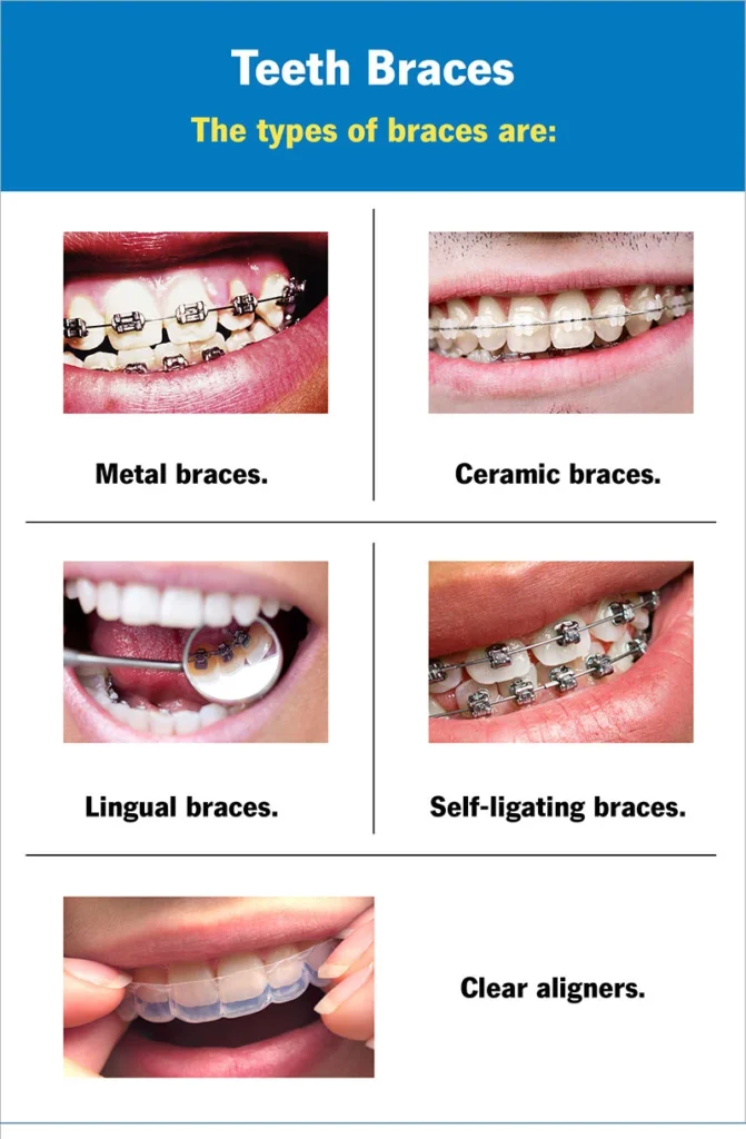 Braces