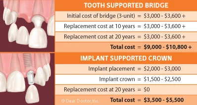 Bridge Work Dental Cost