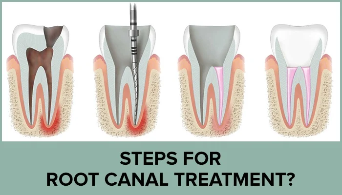 CANAL ROOT TREATMENT (Signs, Pain Relief & Cost) 6 CANAL ROOT TREATMENT