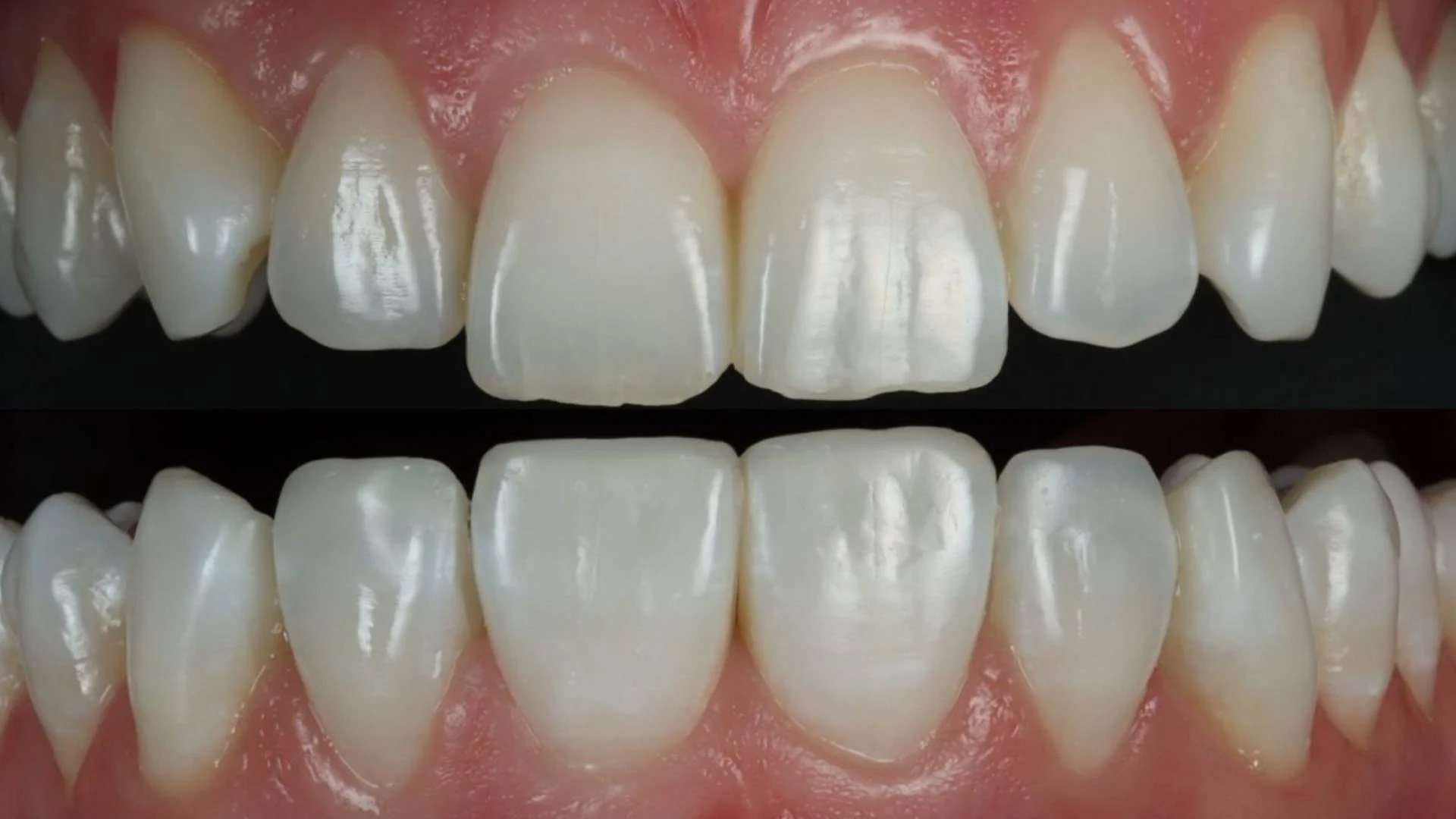 Composite Dental Bonding