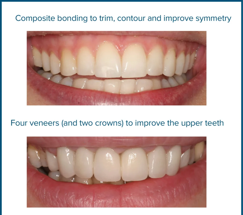 Composite Resin Bonding Teeth (Smile Transformation & No Shaving?) 3 Composite Resin Bonding Teeth
