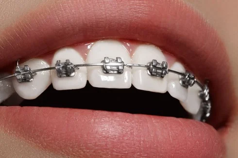 Cost Of Braces UK
