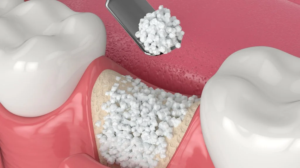 DENTAL BONE GRAFT SPECIALIST (WHO PERFORMS IT) 15 DENTAL BONE GRAFT SPECIALIST