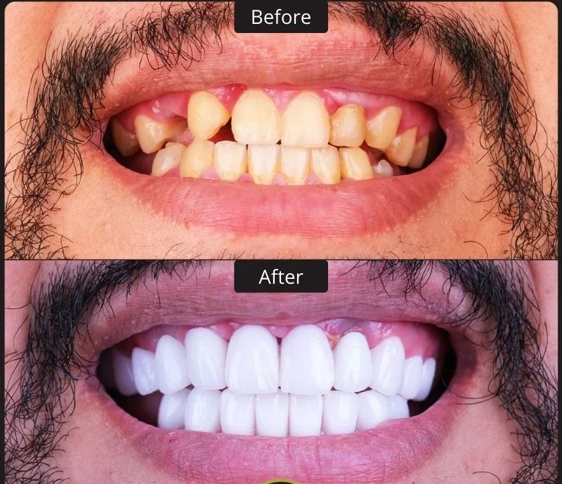 DENTAL IMPLANTS TURKEY