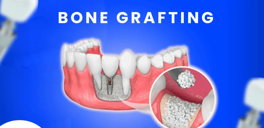 Dental Bone Graft Cost (UK Prices, NHS, Insurance) 6 Dental Bone Graft Cost