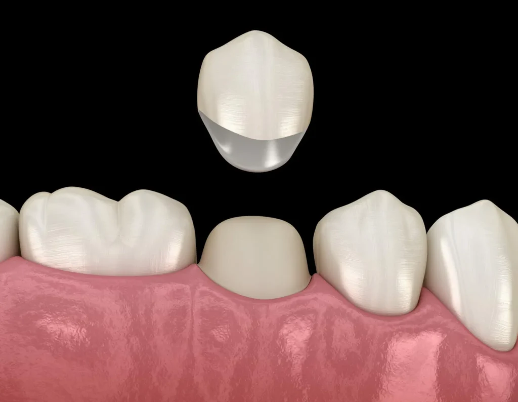 Dental Crowns (Types, Costs, and Procedures Explained) 28 Dental Crowns2 Dental Crowns (Types, Costs, and Procedures Explained)
