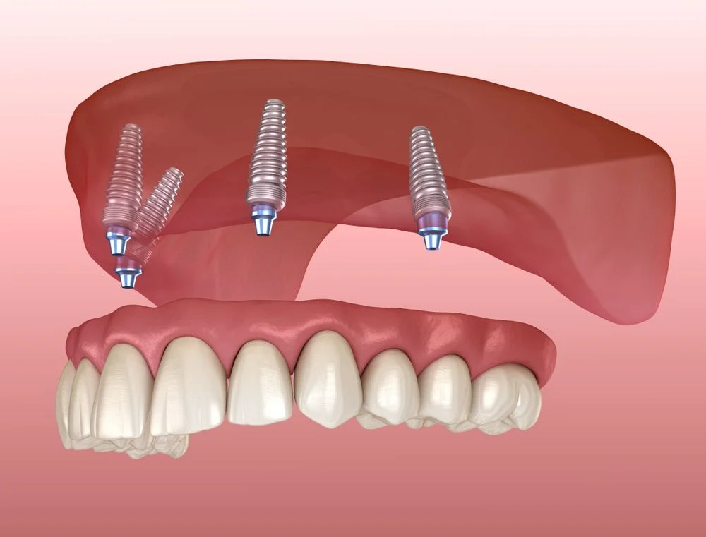 Dental Implants All On Four